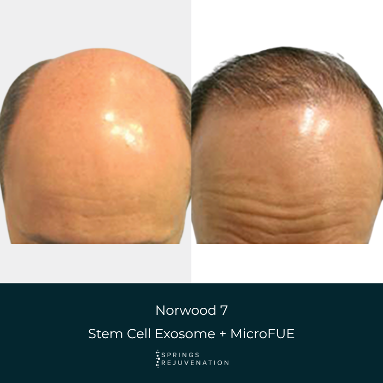 Before and After Results